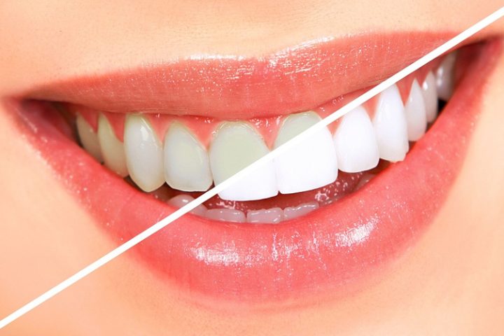 Відбілювання Зубів: Як Воно Працює та Що Варто Знати Перед Процедурою